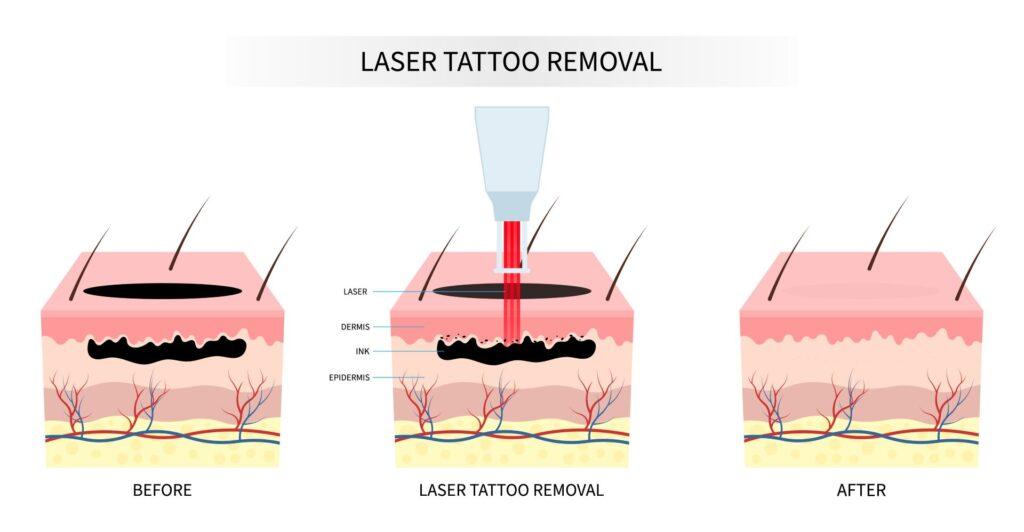 Laserbehandlung für Tattooentfernung